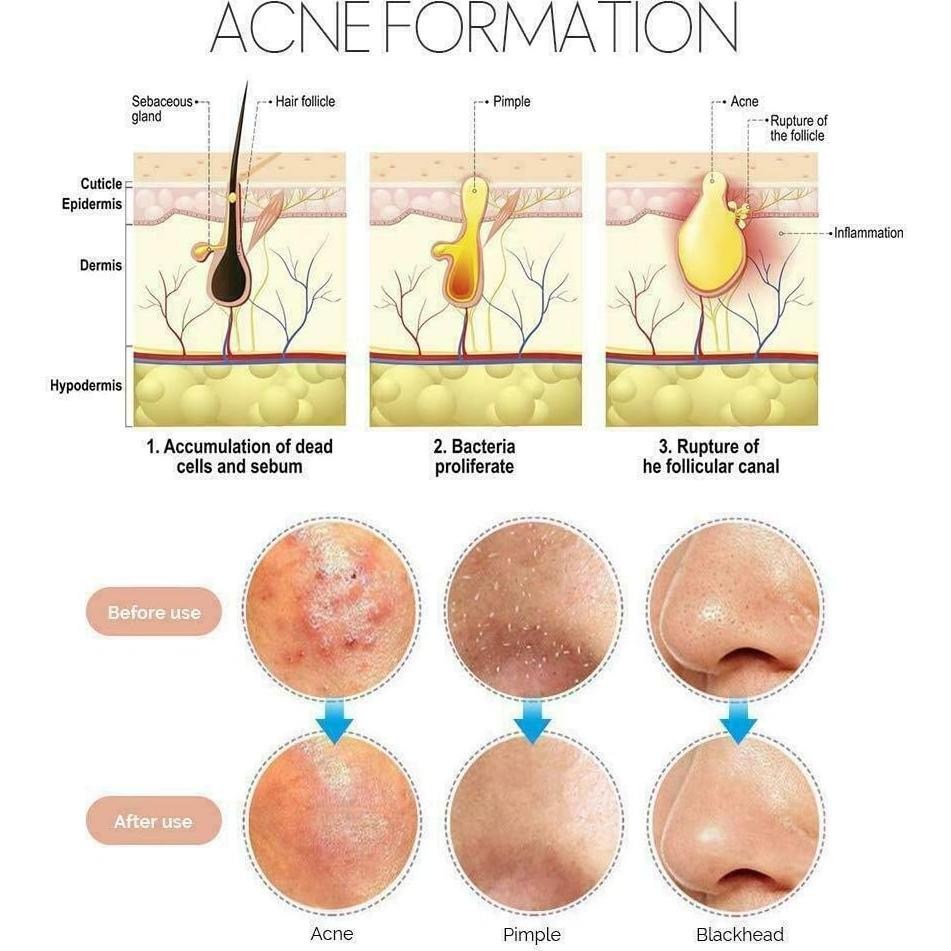 Kit de Extractores de Puntos Negros Krisp Beauty 4 Piezas