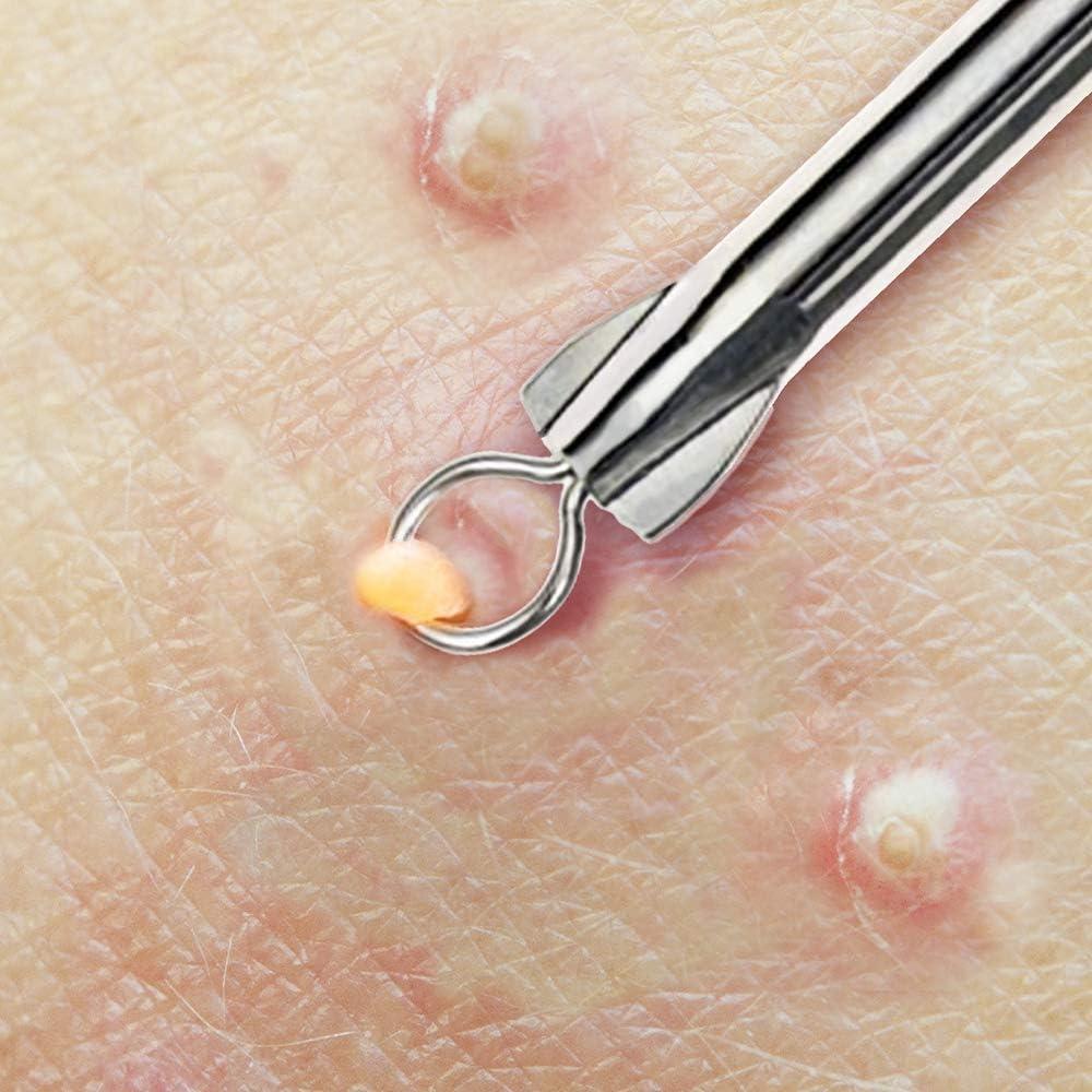 Beaute Galleria Eyehole Blackhead Remover Pimple Extractor Popper for Acne Comedone Blemish Whitehead Zit Removal Tool