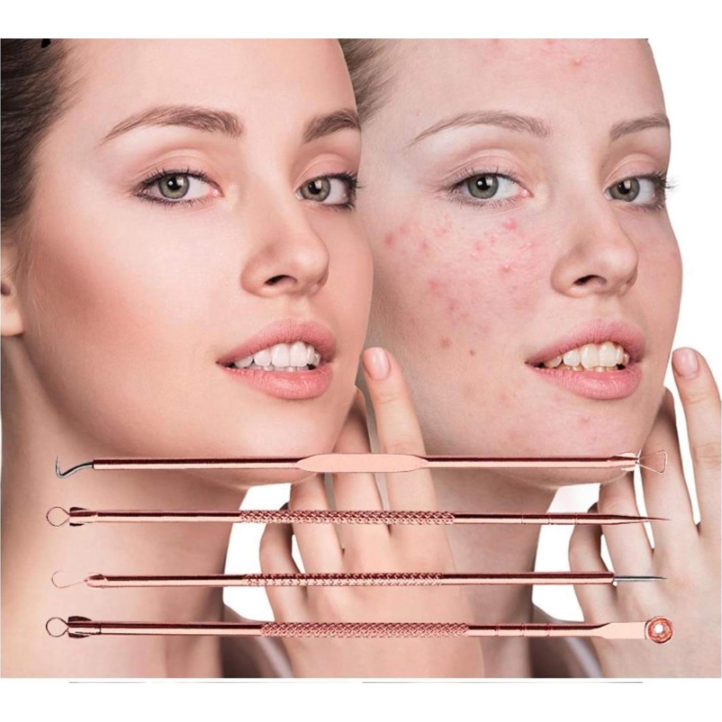 Kit Extractor de Puntos Negros Euxor - 4 Piezas Rosa