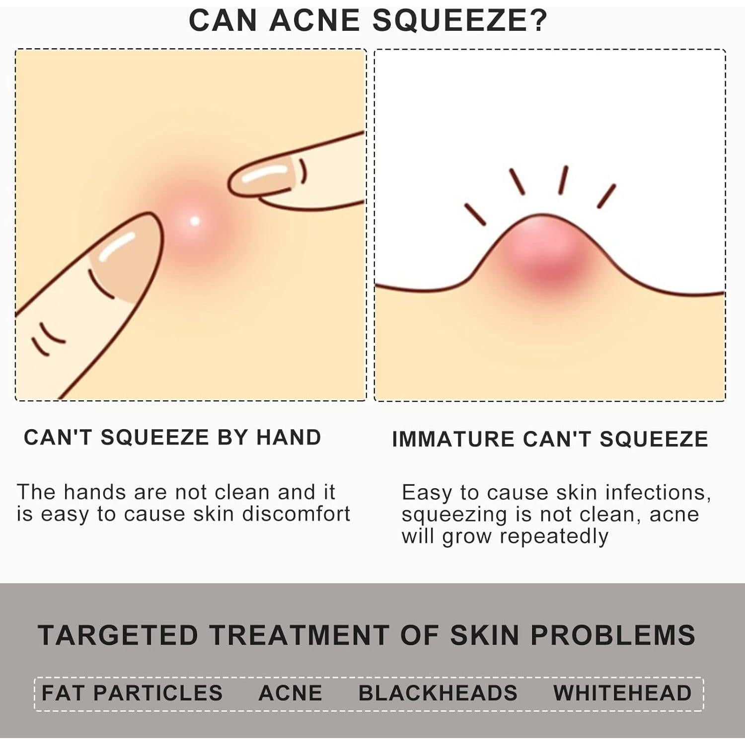 Extractor de Puntos Negros MUZEFAZHAN Acero Inoxidable 2 en 1