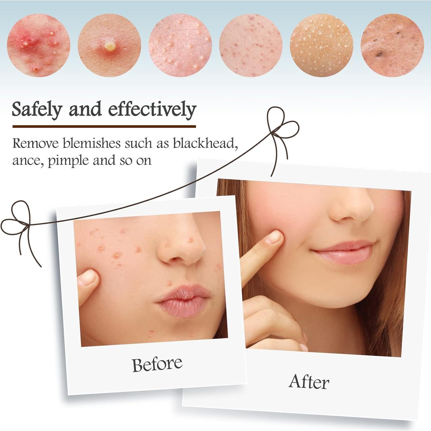 Kit de Extracción de Espinillas MORGLES 14 Piezas Acero Inoxidable