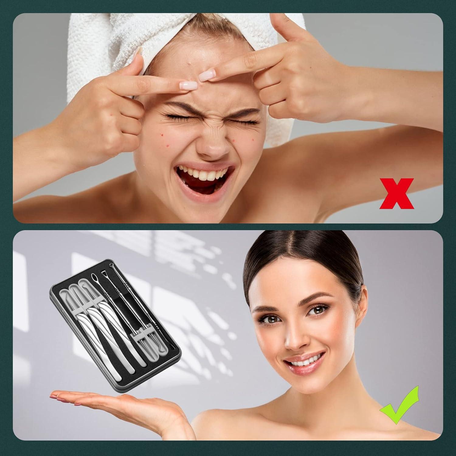 Kit Extractor de Puntos Negros FVION 6 Piezas Acero Inoxidable