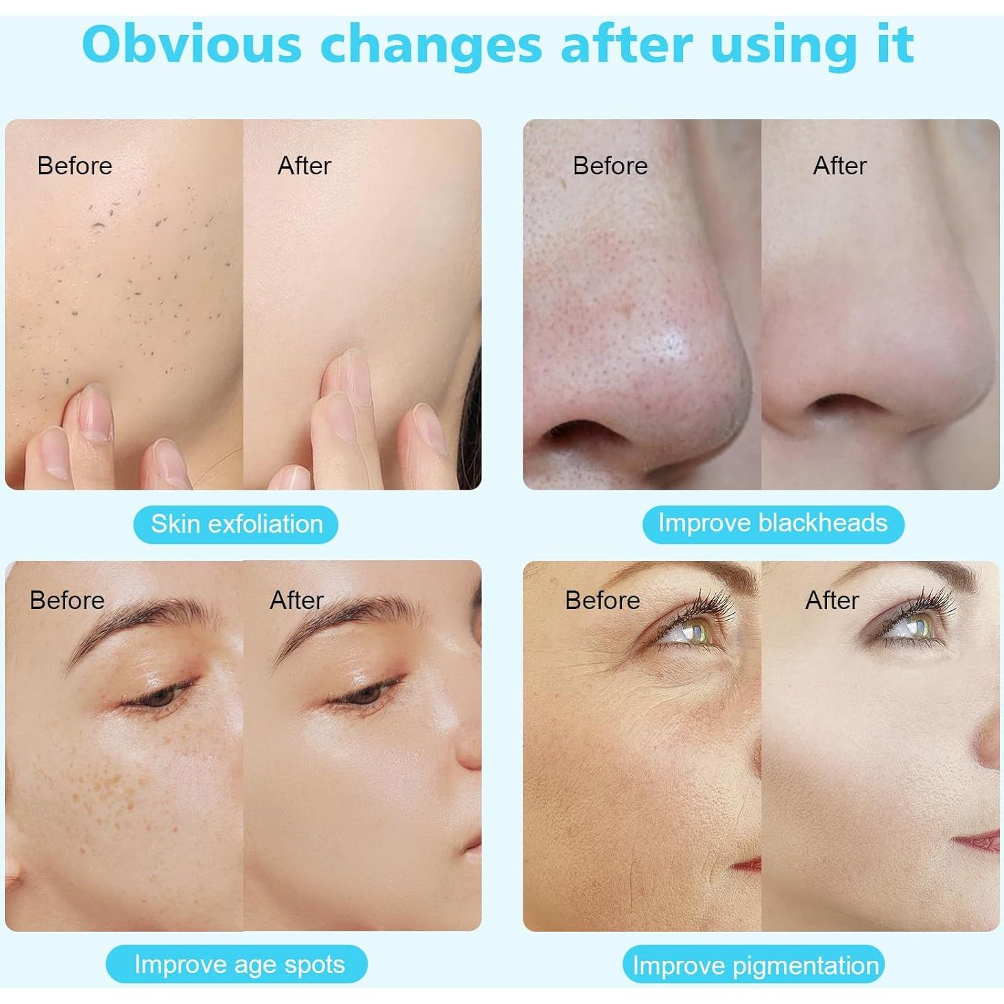 Máquina de Microdermoabrasión 3 en 1 Mcwdoit Cuidado Facial