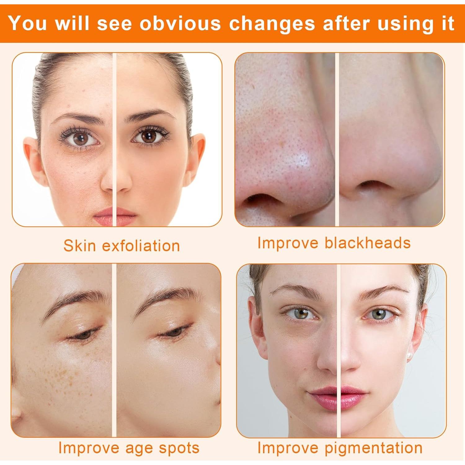 Máquina de Microdermoabrasión Mcwdoit 3 en 1 Facial Exfoliación