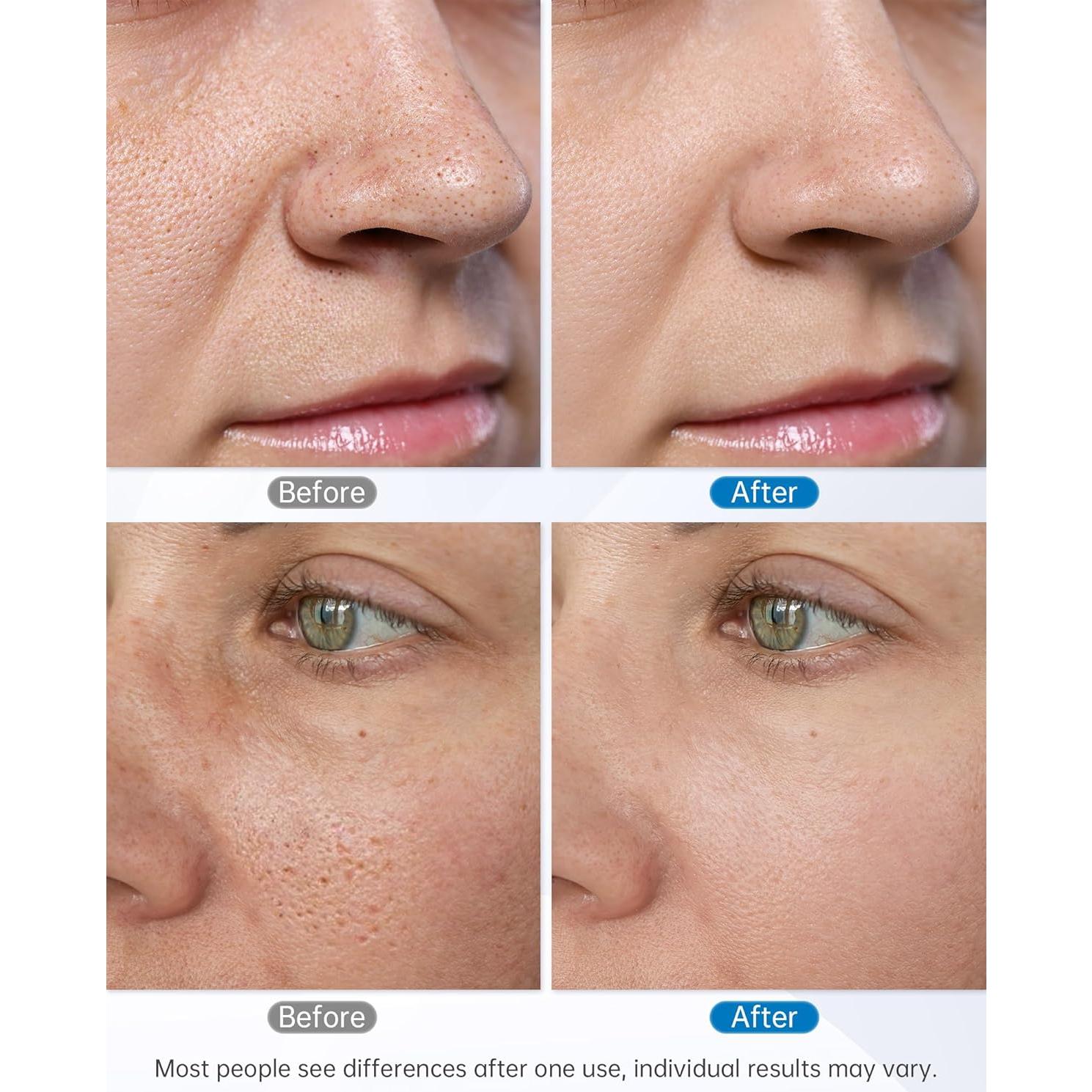 Máquina de Microdermoabrasión Facial UNOISETION 2 en 1