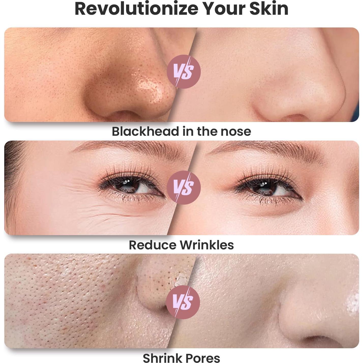 Máquina de Microdermoabrasión UNOISETION Rosa Inalámbrica