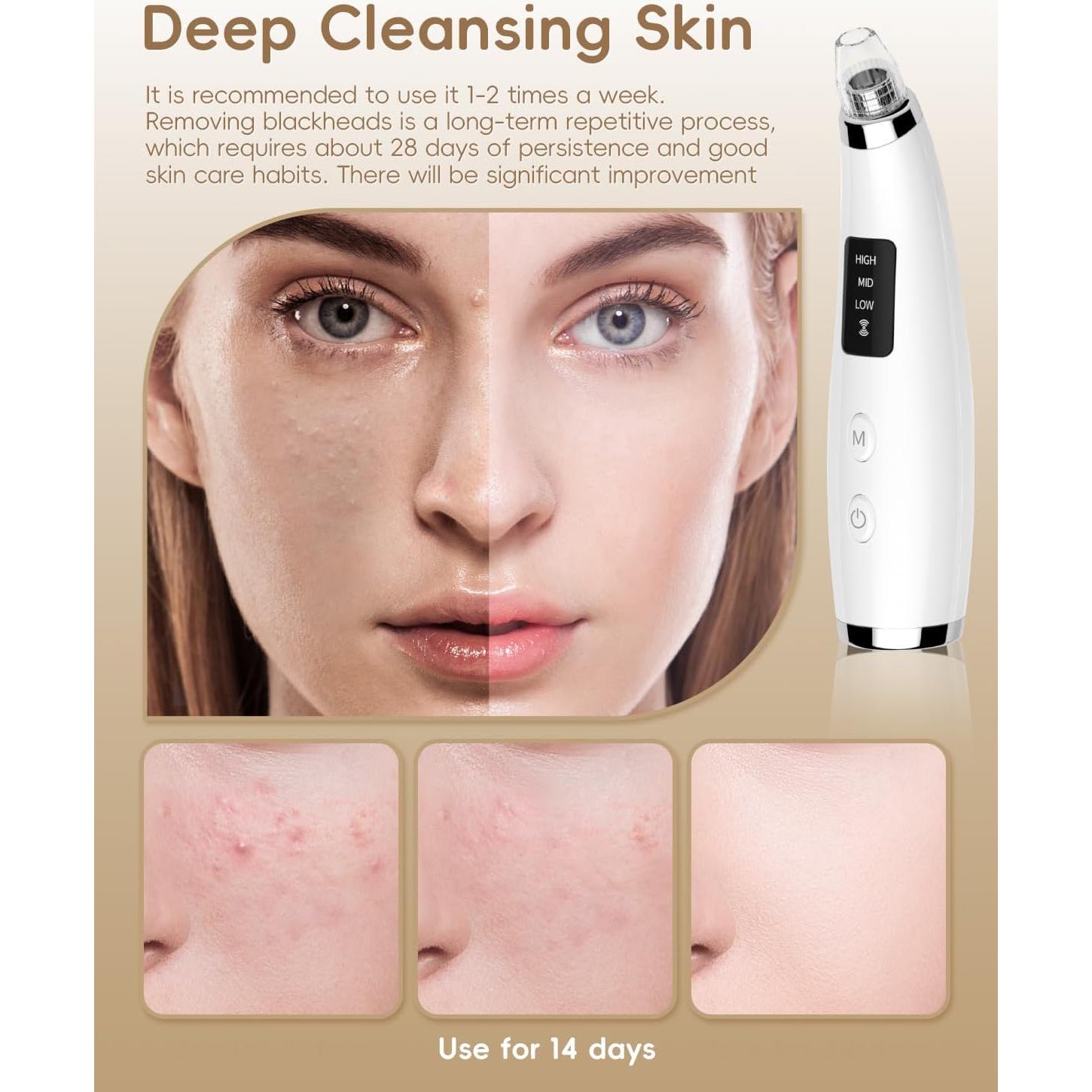 Removedor de Puntos Negros FLYMOOO Blanco 3 Niveles Succión