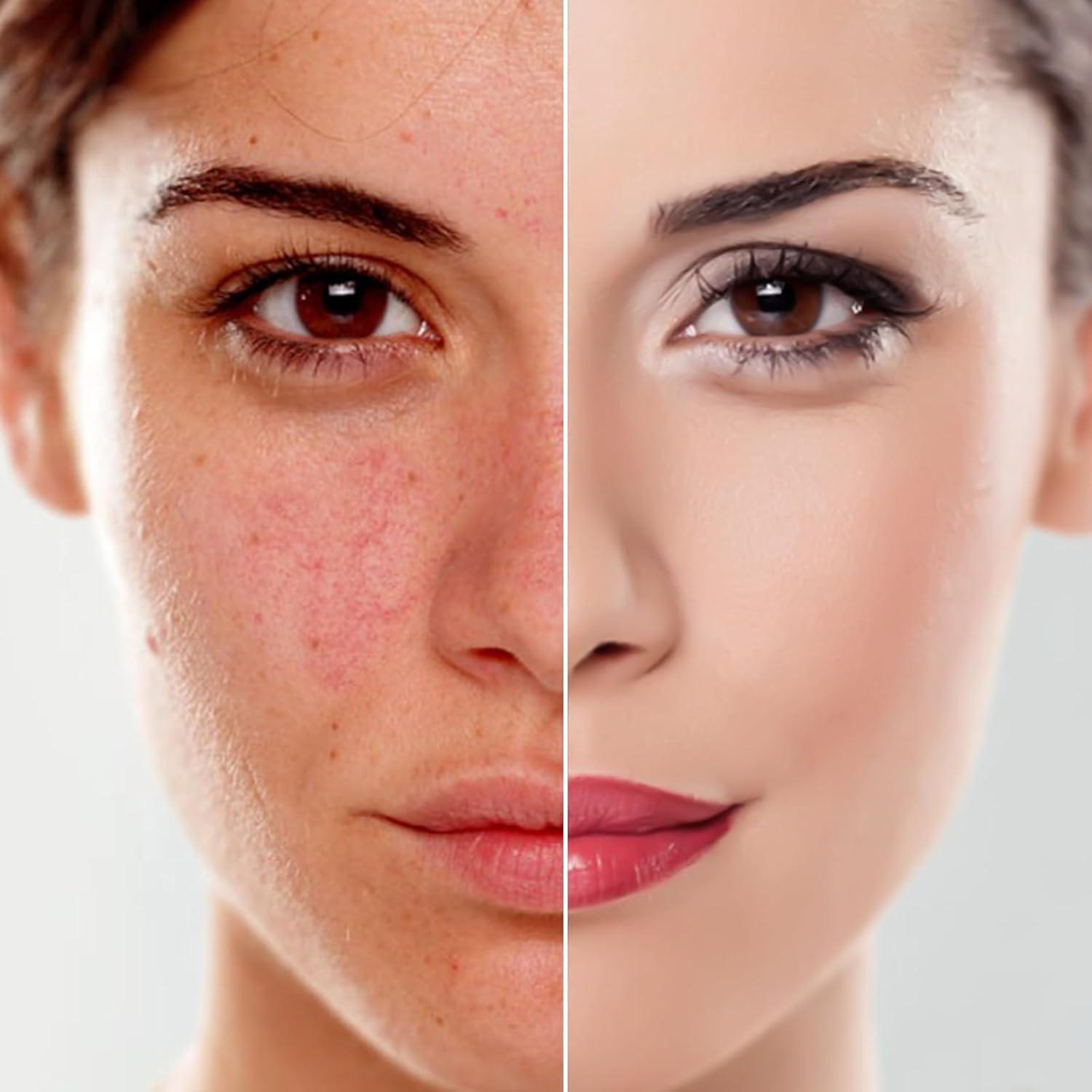 Máquina de Microdermoabrasión 3 en 1 mcwdoit 30,4x23,6cm