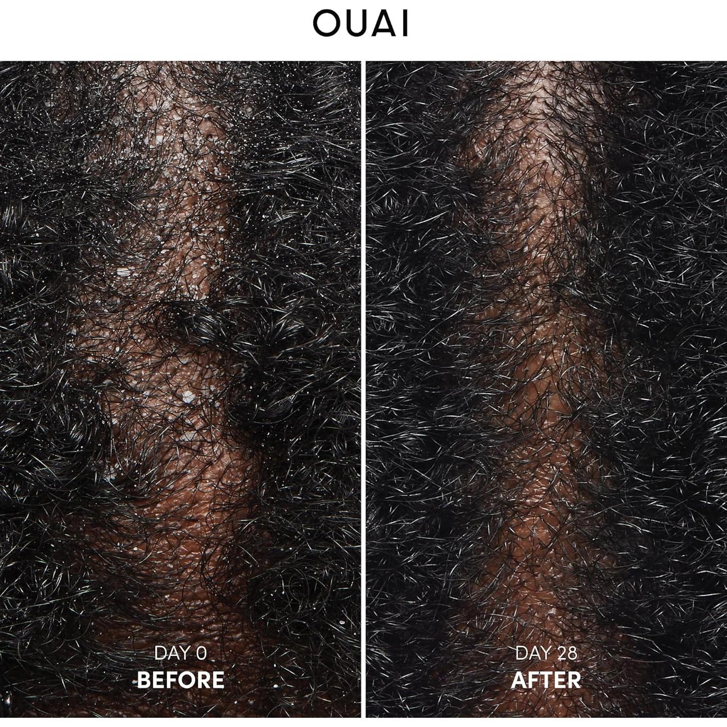 Champú Anticaspa OUAI 300 ml - Suave con Ácido Salicílico