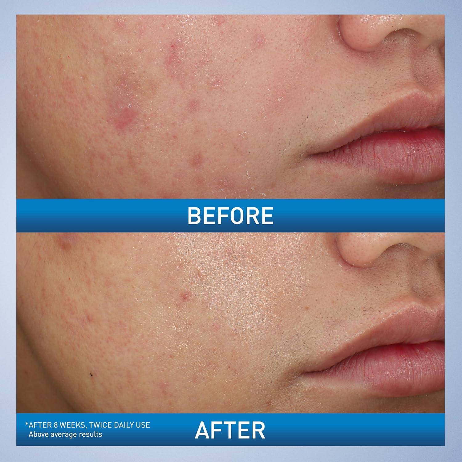 CeraVe Limpiador Espumoso para Acné 10% Peróxido 141g