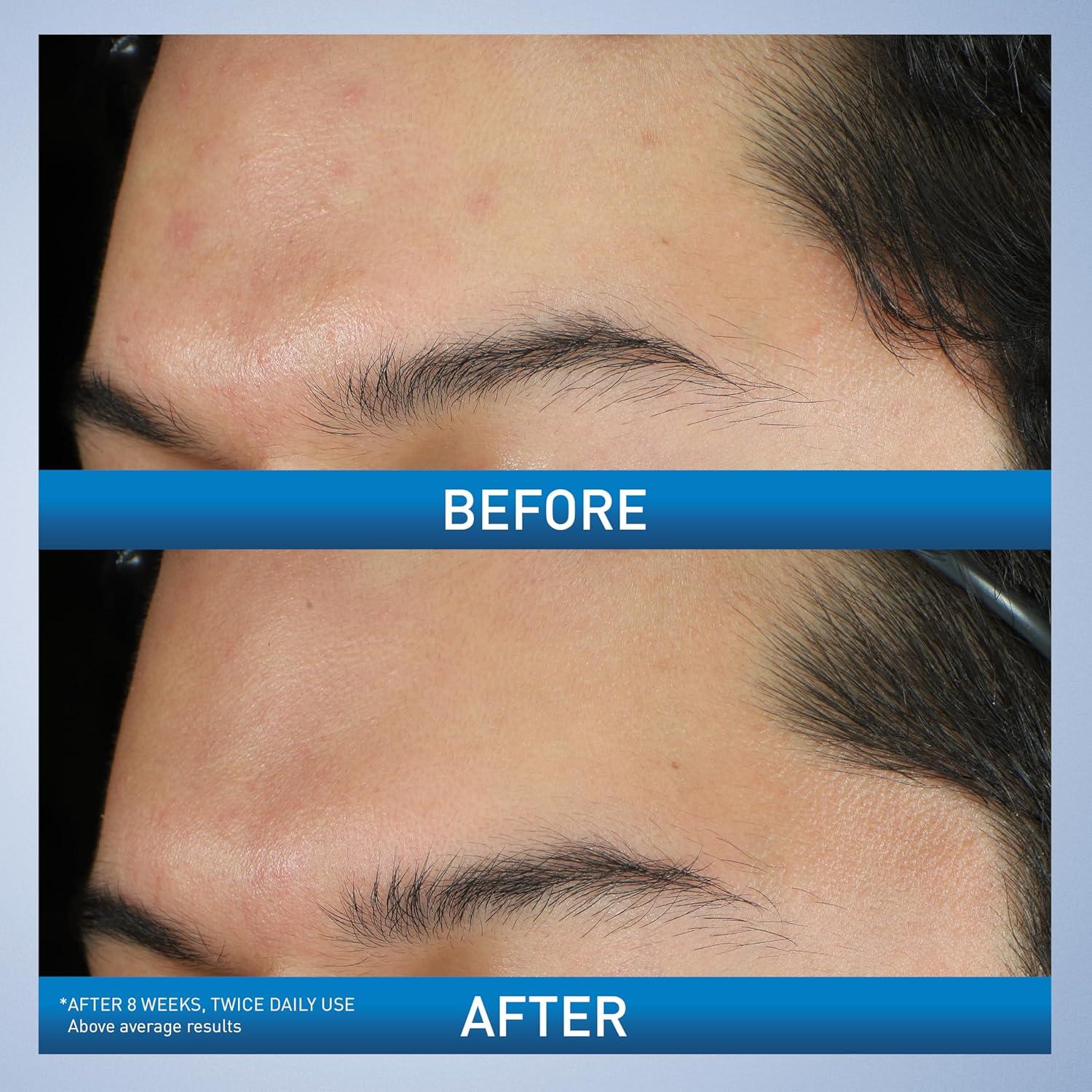 CeraVe Limpiador Espumoso para Acné 10% Peróxido 141g