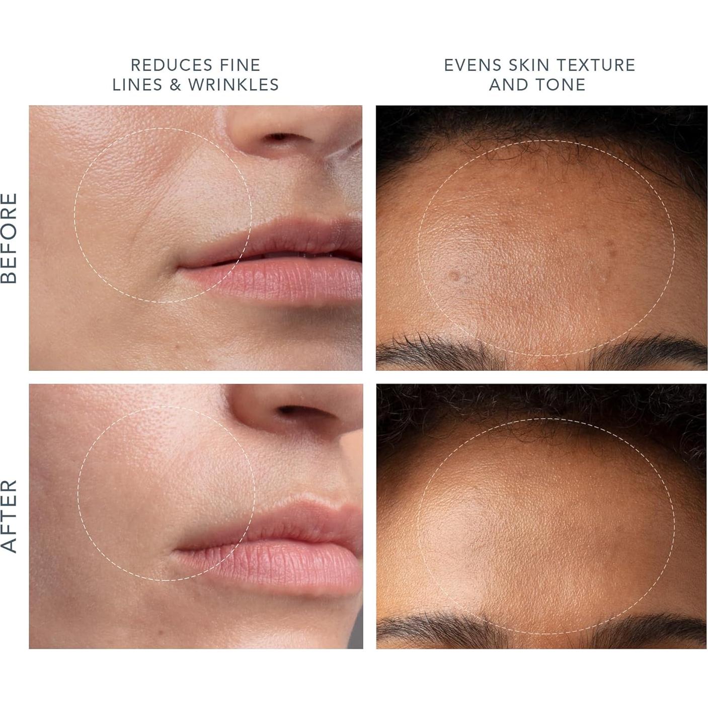 Extractor de Puntos Negros FOREO KIWI - Microdermoabrasión