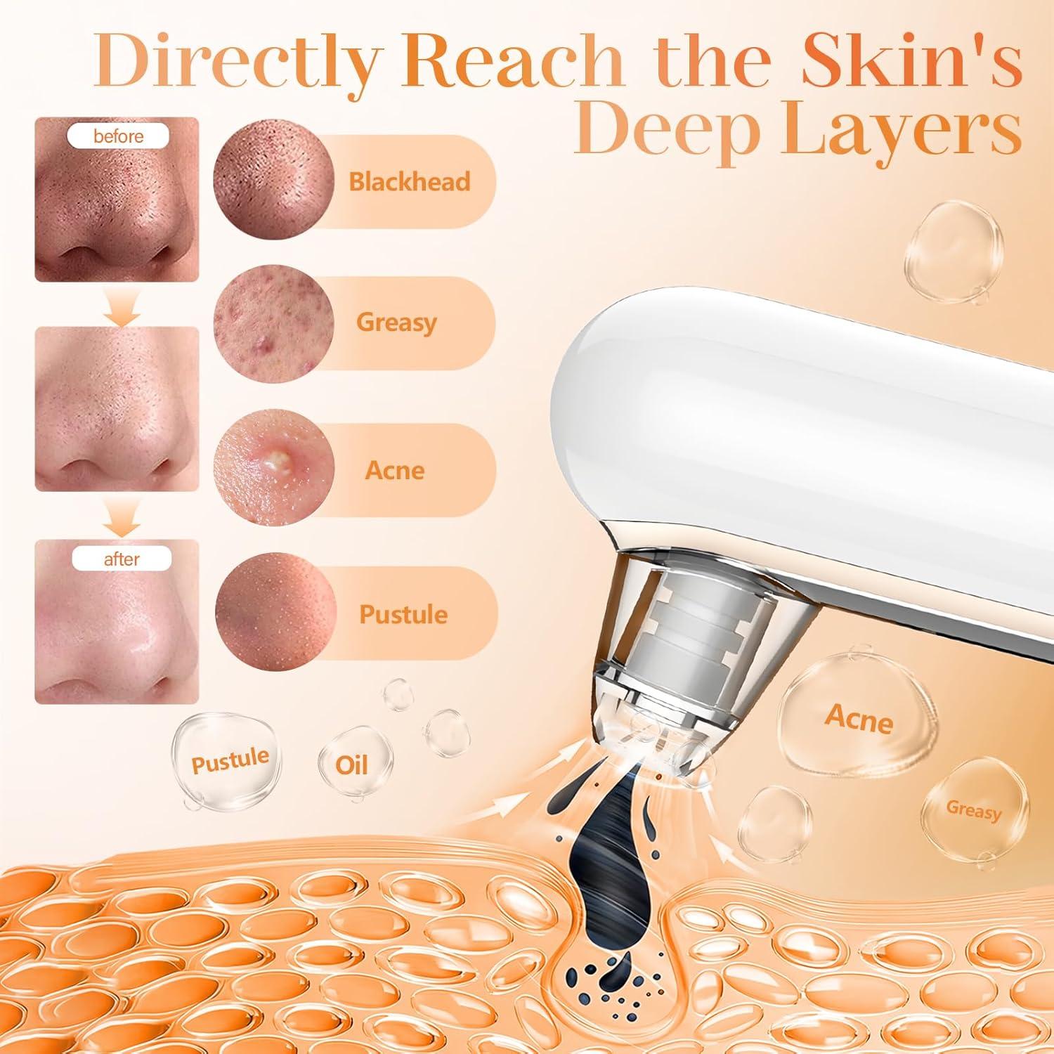 Extractor de Puntos Negros Yccu con 4 Modos y 5 Cabezas