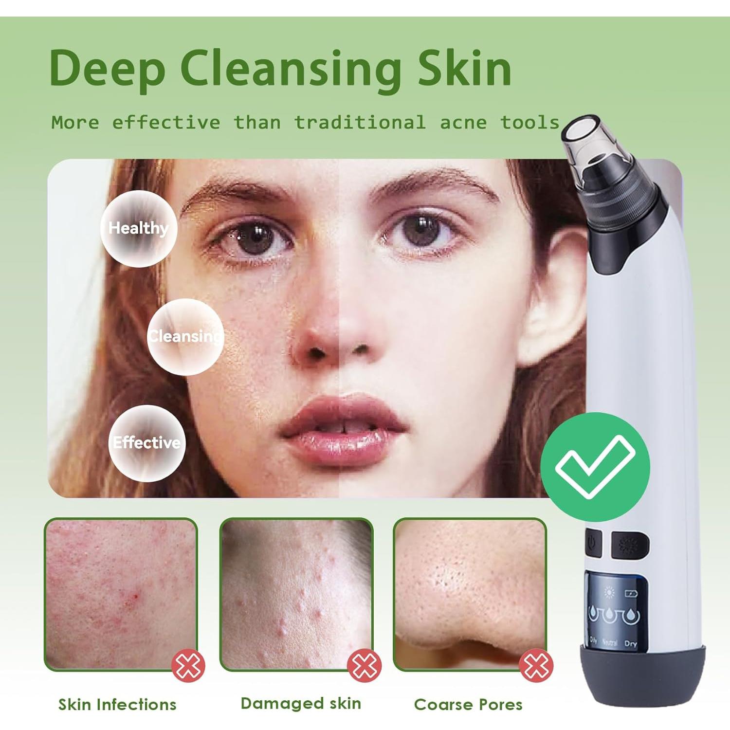 Aspiradora de Puntos Negros Xamoca USB 3 Niveles 4 Probes