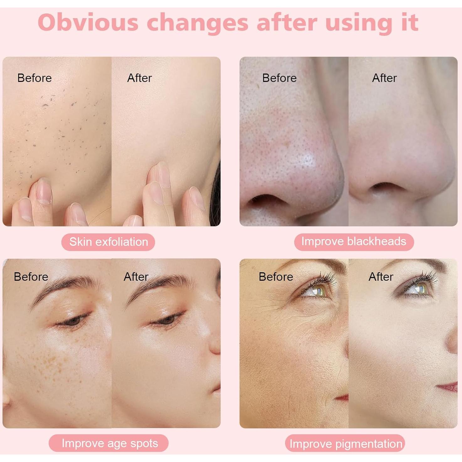 Máquina de Microdermoabrasión Mcwdoit 3 en 1 Cuidado Facial