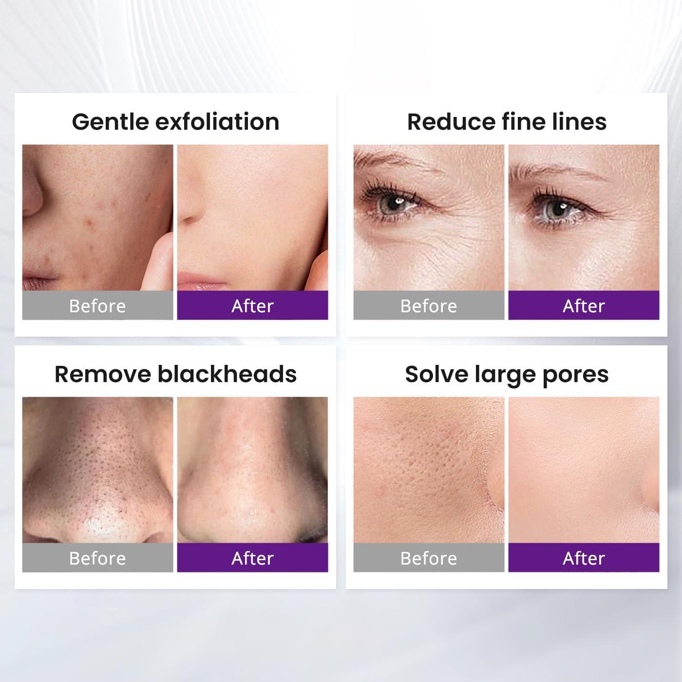 Máquina de Microdermoabrasión UNOISETION MS-22P3 3 en 1