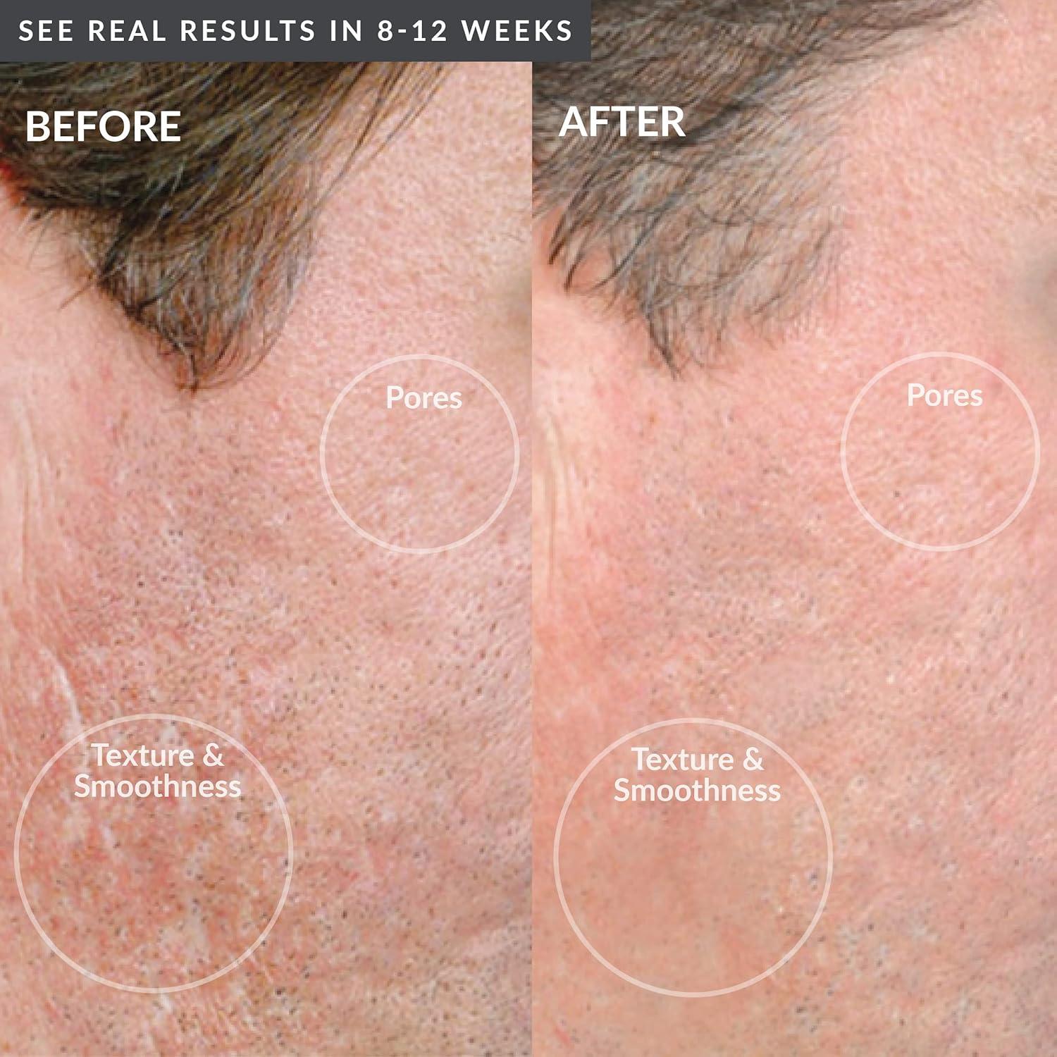 Máquina de Microdermoabrasión PMD Beauty para Hombre - Kit Facial y Corporal