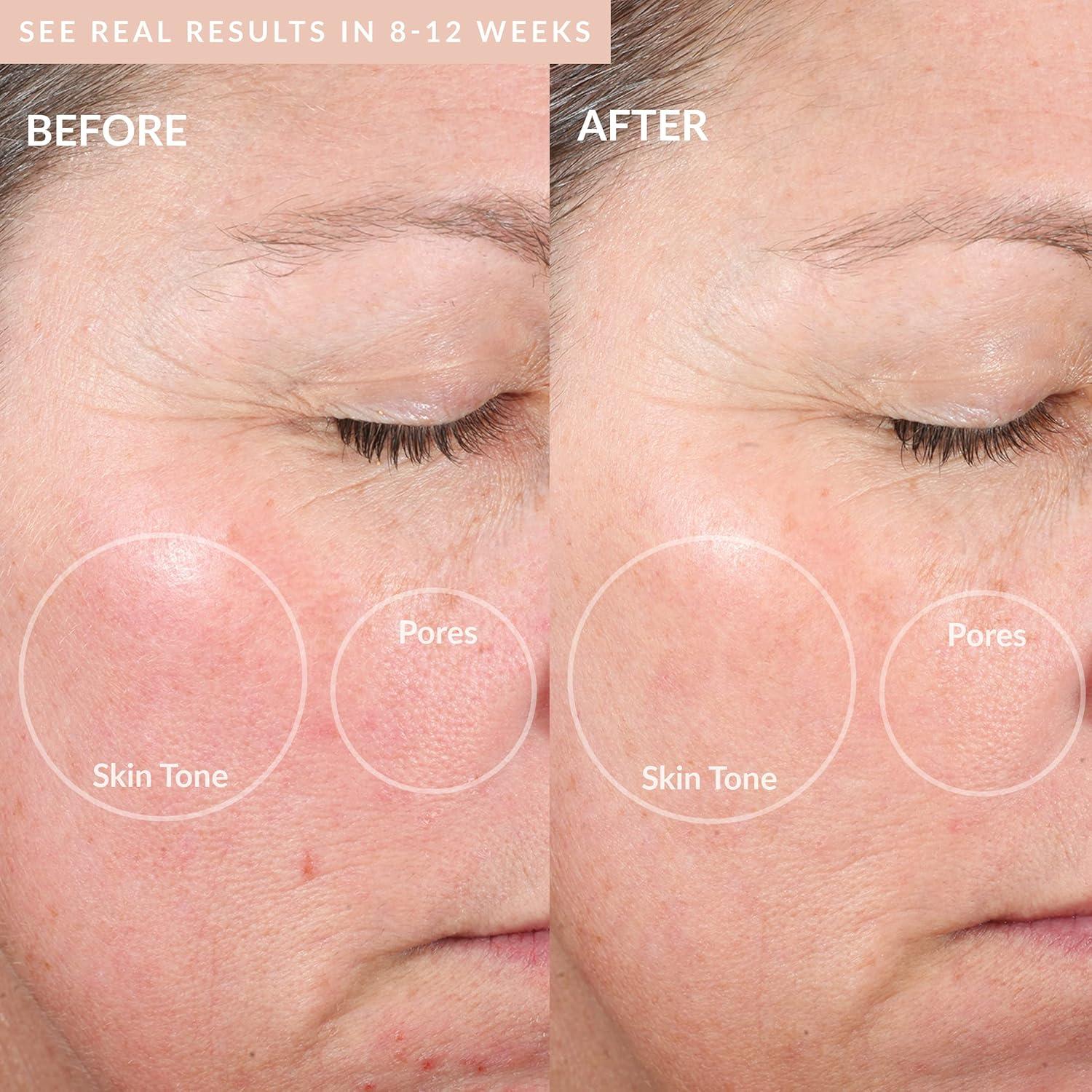 Máquina de Microdermoabrasión PMD Beauty Elite Pro - Exfoliación Facial y Corporal