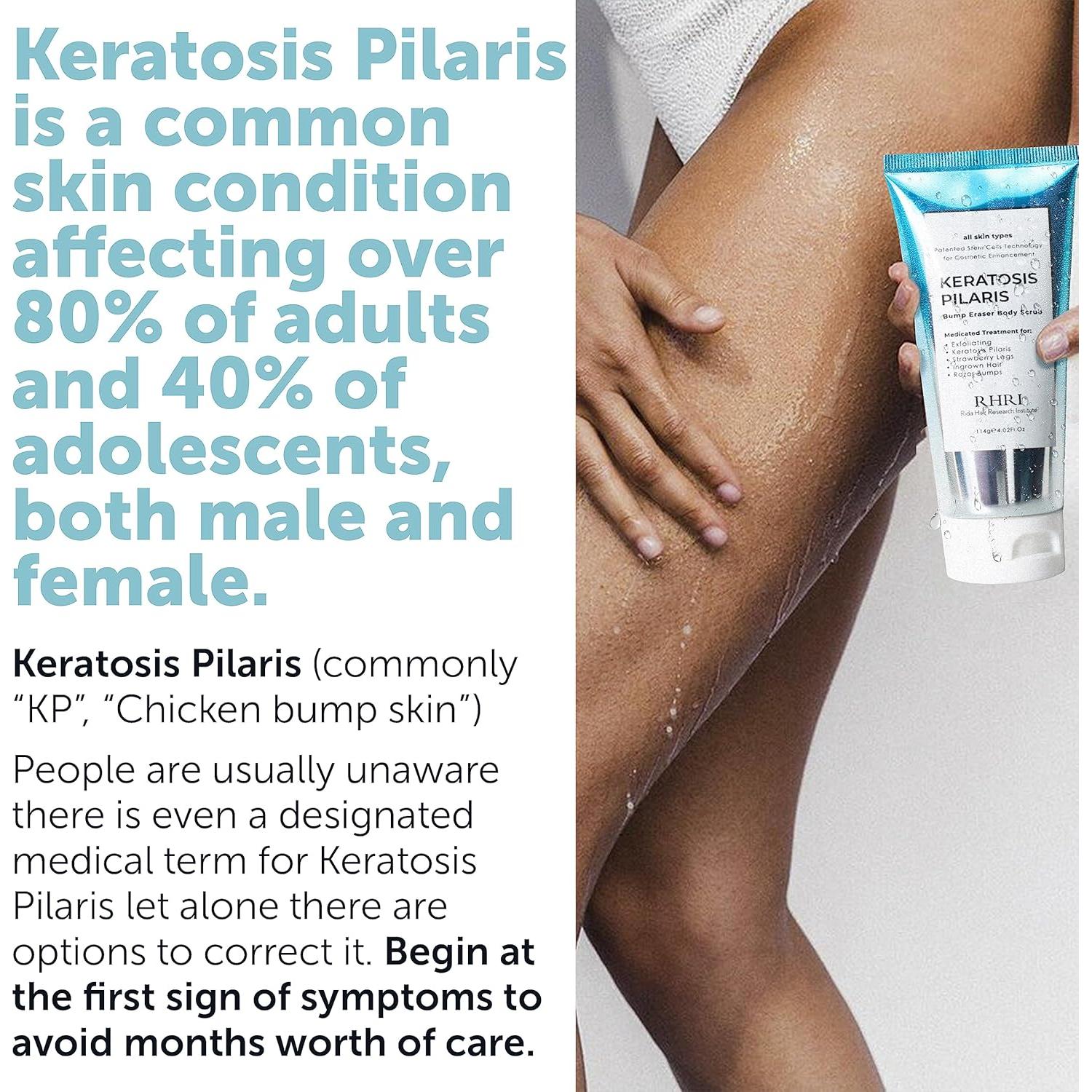 Exfoliante Corporal KP Bump Eraser 15,6x6,3 cm - Hidratante