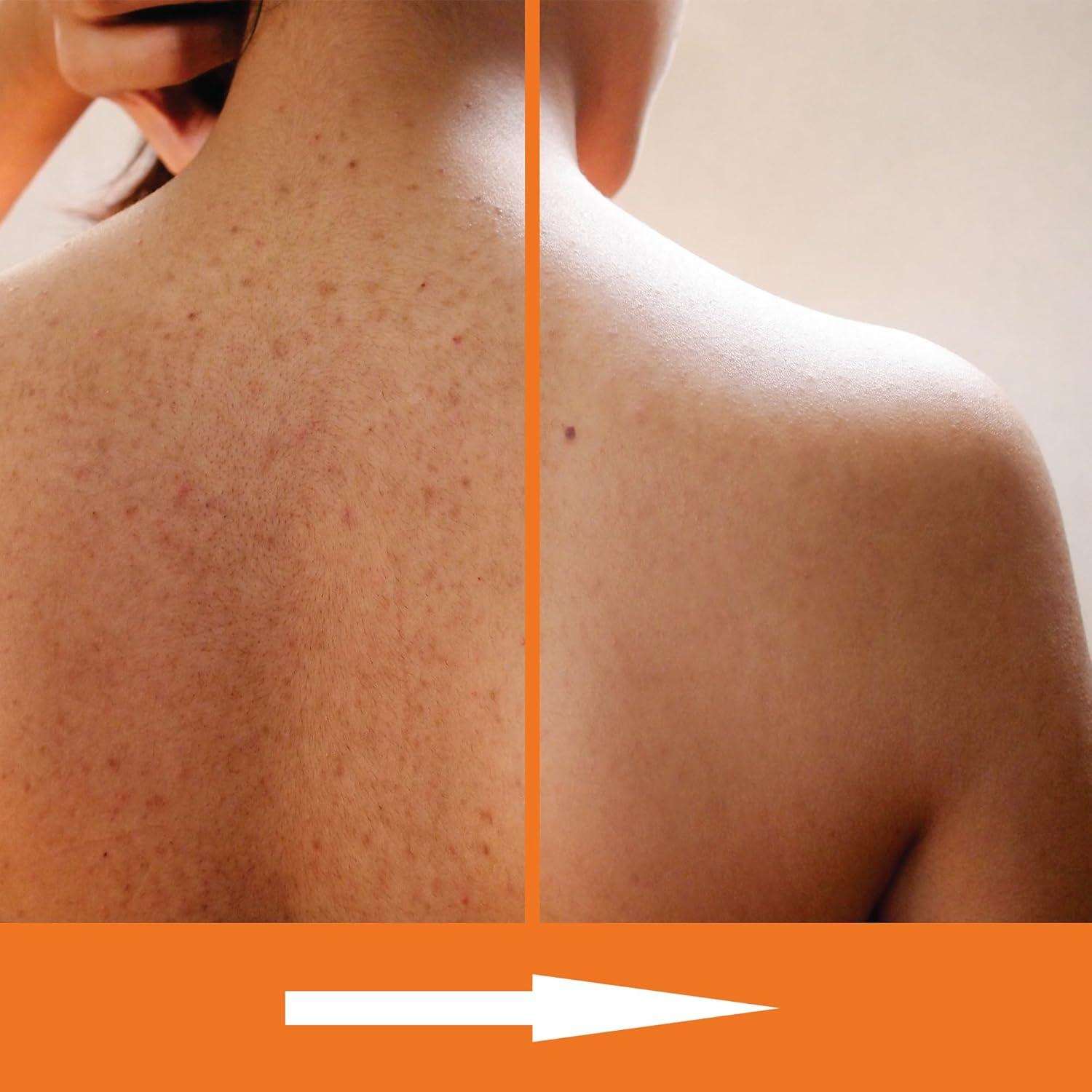 Jabón Corporal Exfoliante KERAPIL Ácido Salicílico 2 Pk