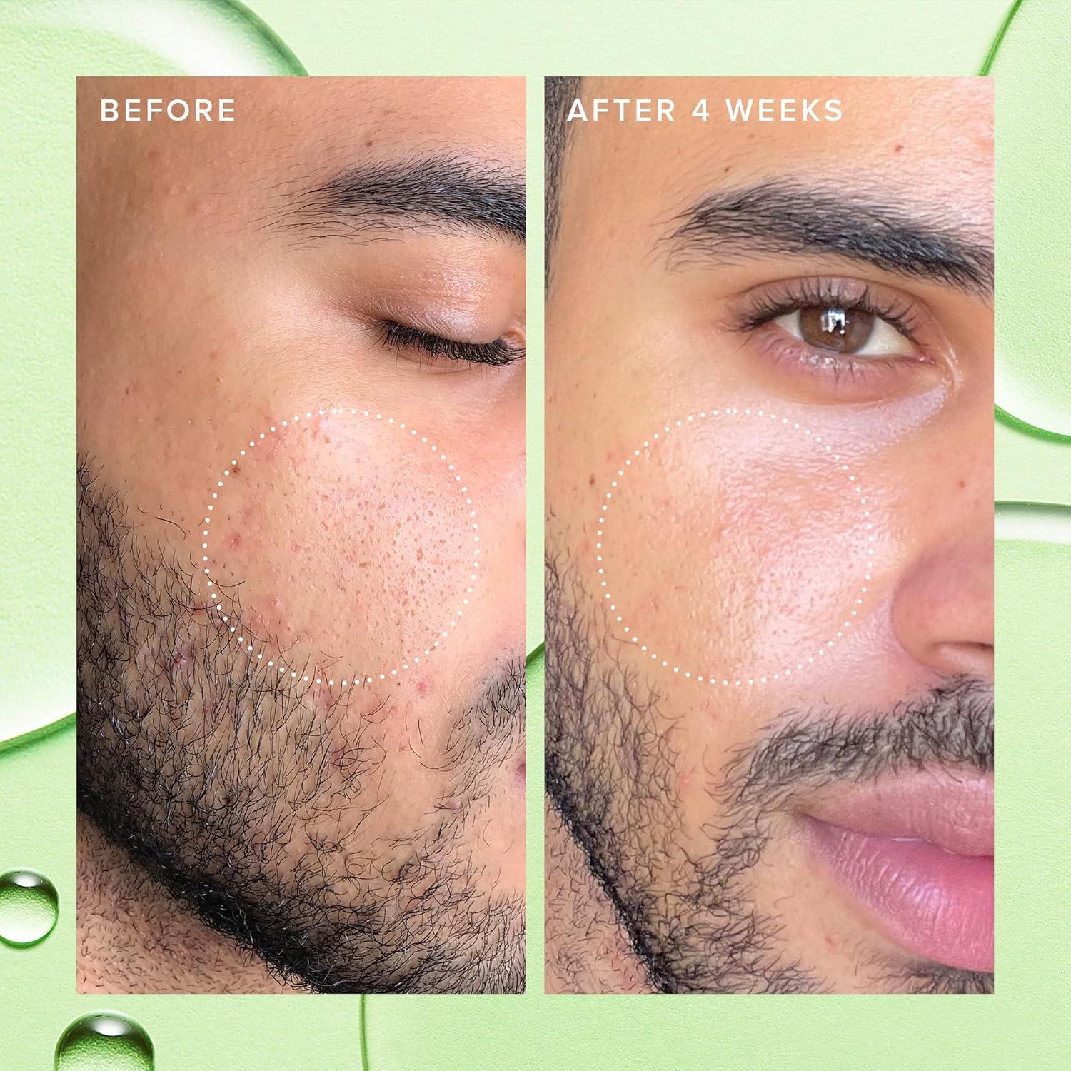 Tónico Facial Ácido Salicílico 2% Farmacia 50ml Piel Grasa