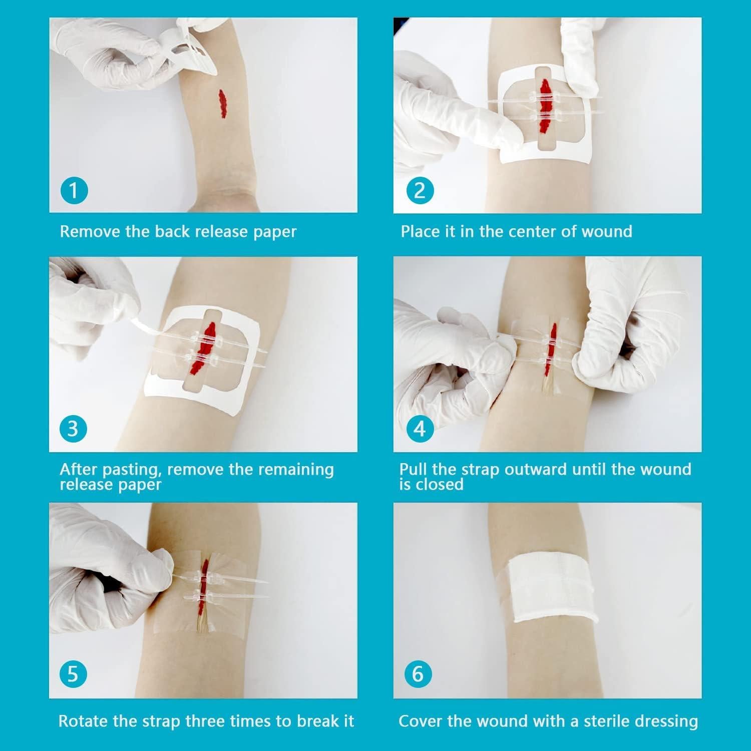 Kit de Cierre de Heridas Greetmed 4 Piezas Sin Dolor