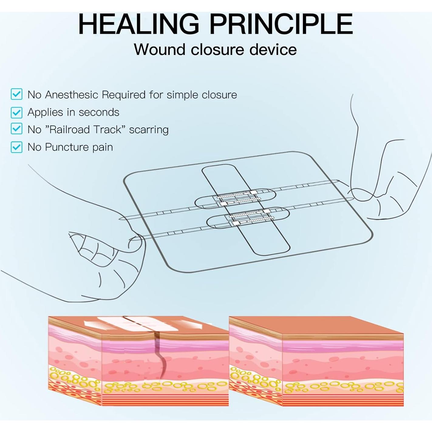 Cierre de Heridas Sin Puntos MaiWieel 2 Piezas 15x10cm