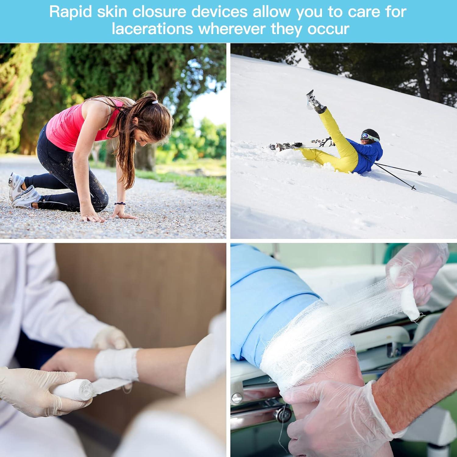 Cierre de Heridas Sin Puntos MaiWieel 2 Piezas 15x10cm