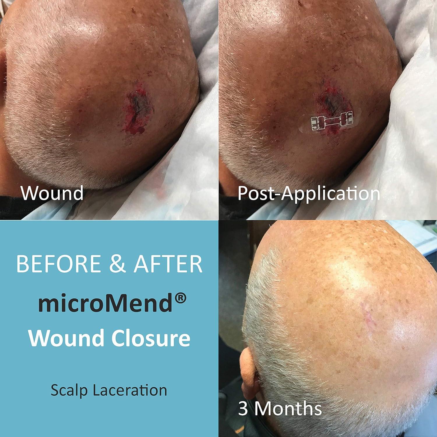 Cierres de Heridas Quirúrgicos microMend - 6 Dispositivos