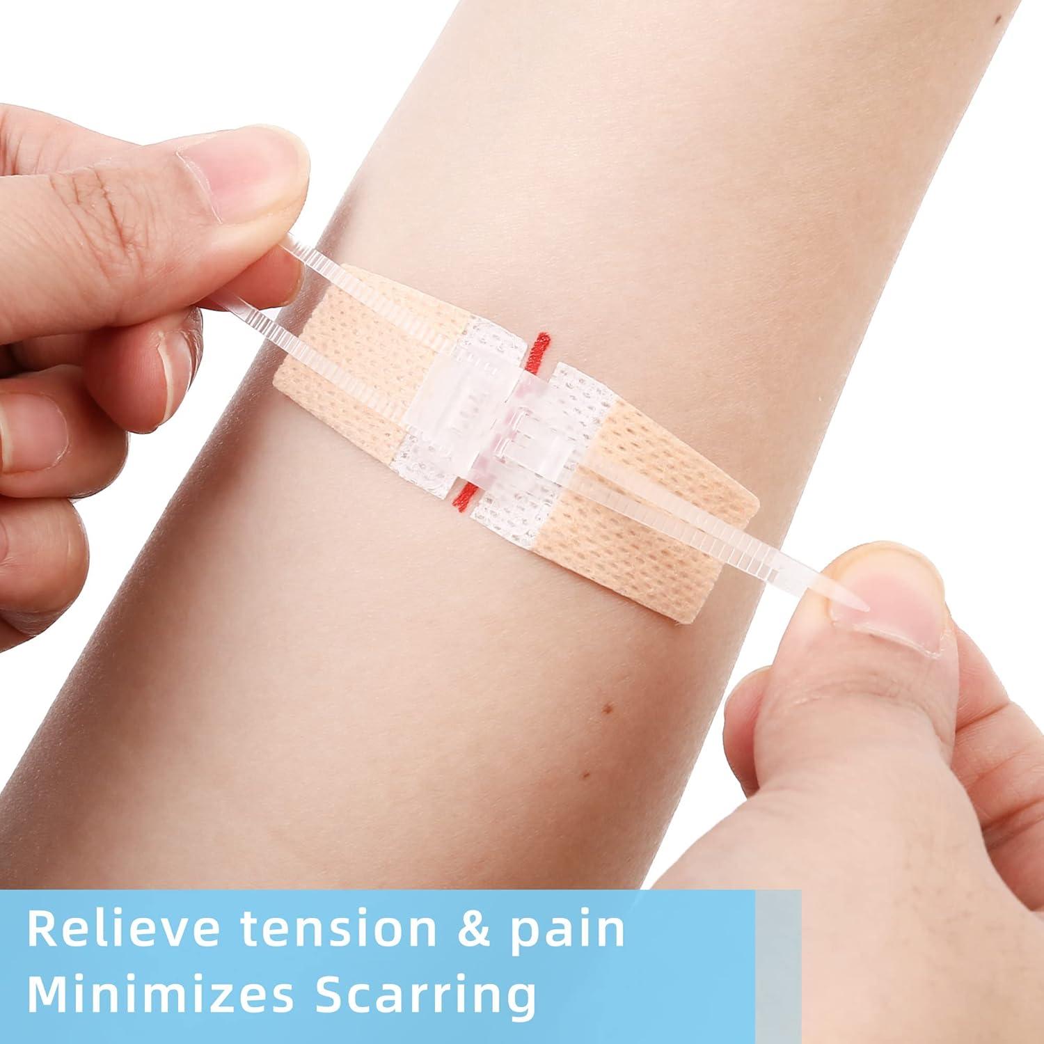 Cierres de Laceración de Emergencia LotFancy, 4 Unidades