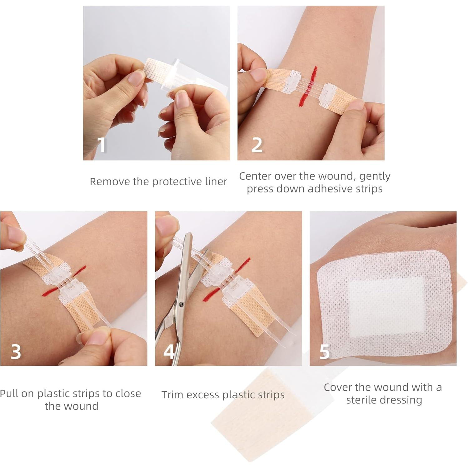 Cierres de Laceración de Emergencia LotFancy, 4 Unidades