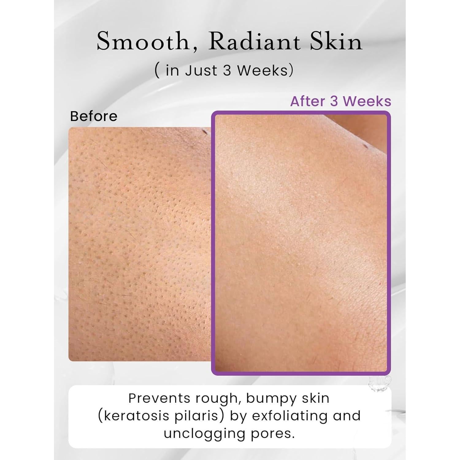 Exfoliante Corporal Elvira KP Bump Eraser 10% AHA BHA 198g