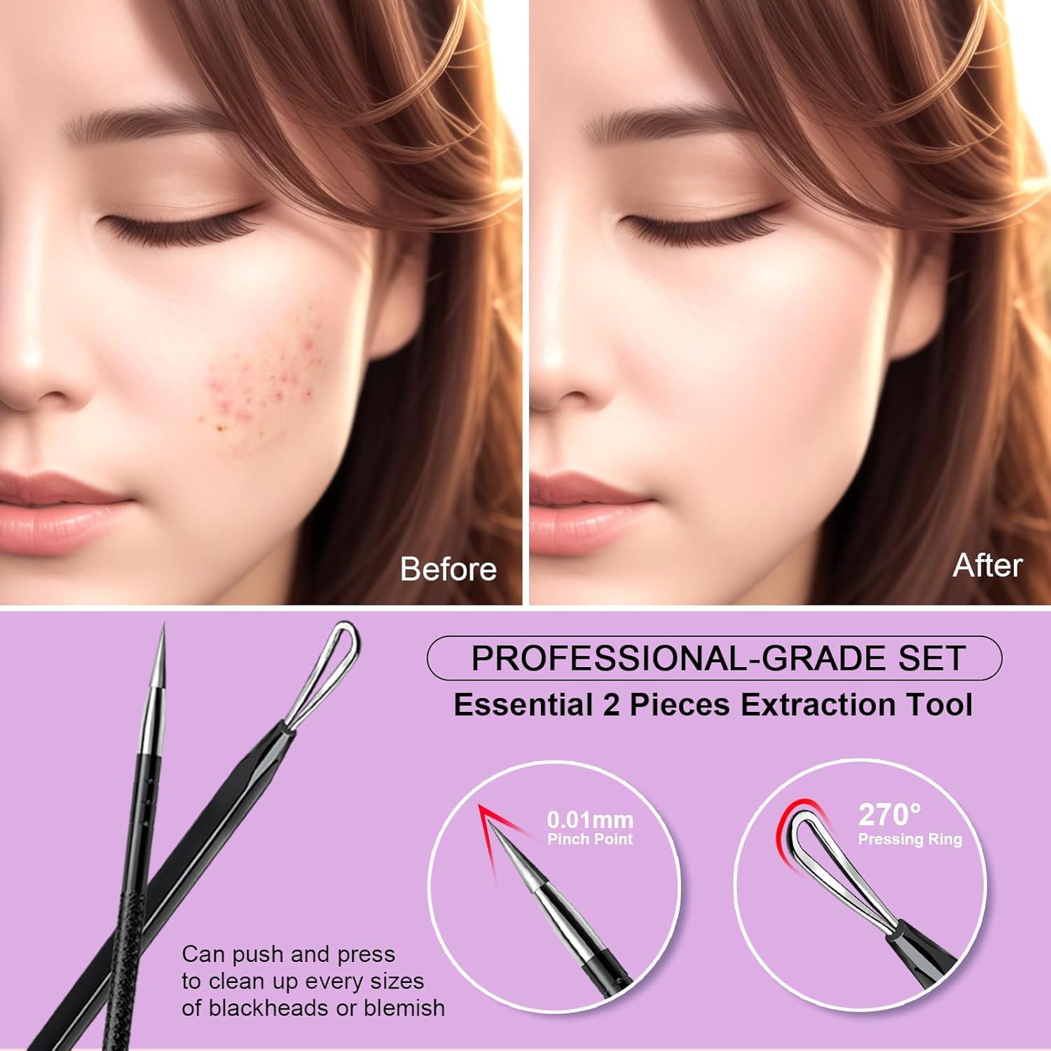 Herramienta Extractora de Espinillas Teenitor 2-en-1 Acero Inoxidable