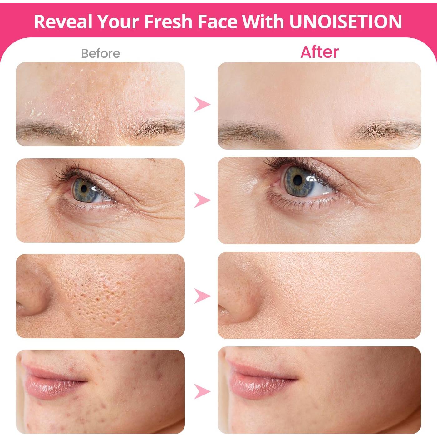 Máquina de Microdermoabrasión UNOISETION 3 en 1 Rosa