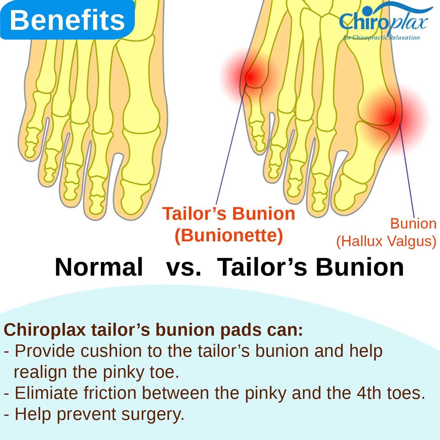 Correctores de Juanetes Chiroplax - 4 Cojines Pequeños