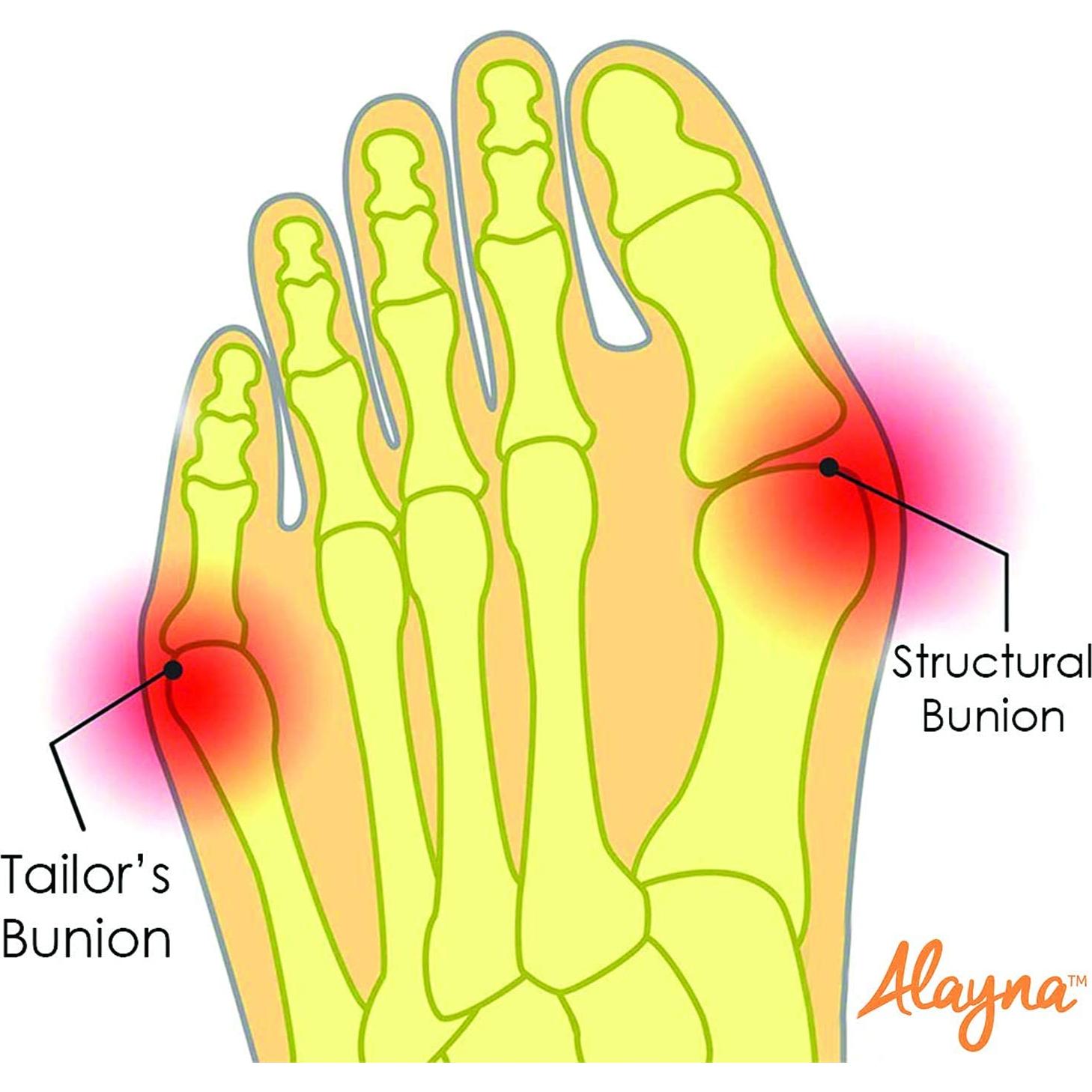 Correctores de Juanetes Alayna Gel Unisex - Alivio y Soporte
