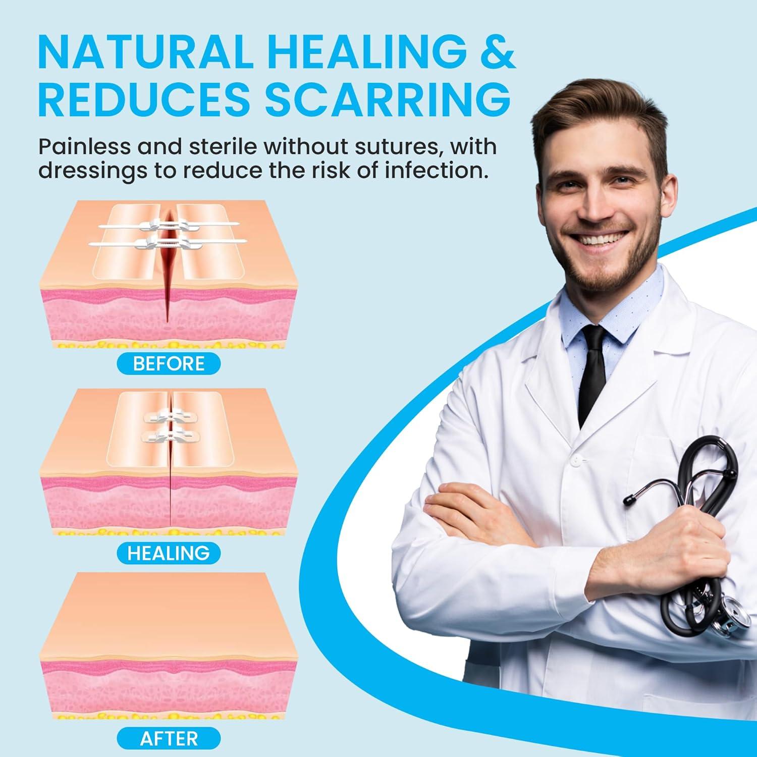 Tiras de Cierre de Heridas Antaly - Kit 4 Paquete Transpirables