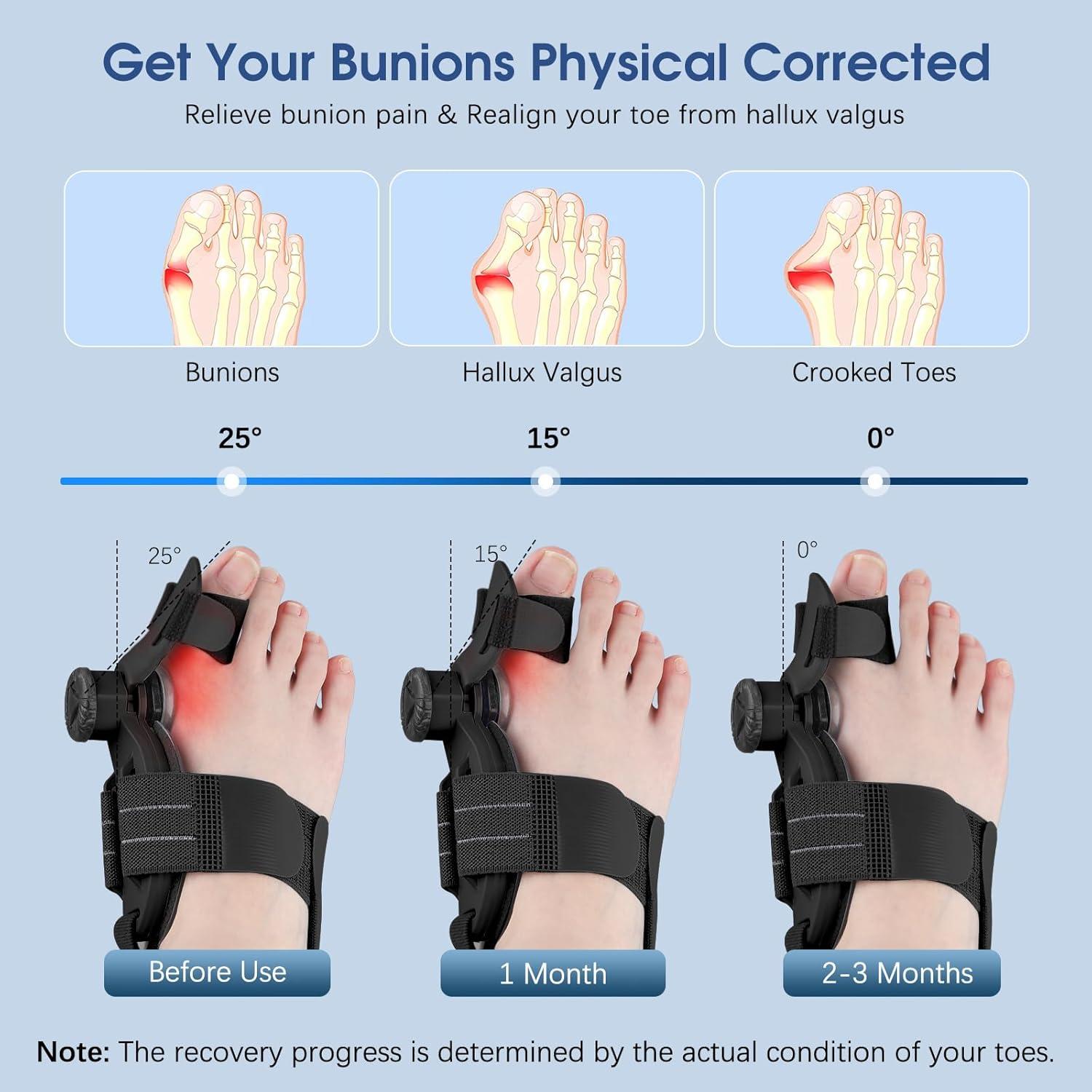 Corrector de Juanetes KASHEVI Ajustable para Alivio del Dolor