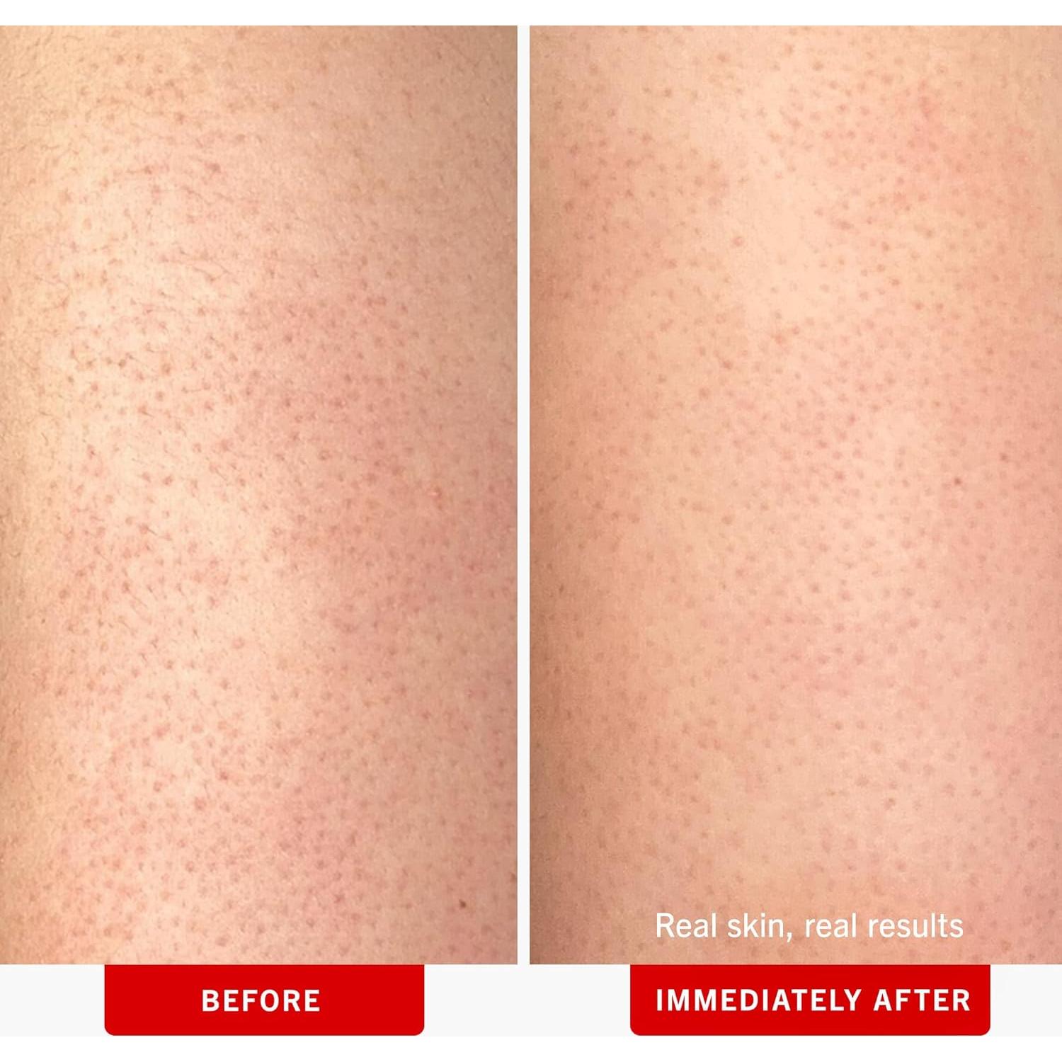 Exfoliante Corporal First Aid Beauty KP Bump Eraser 226.8 g