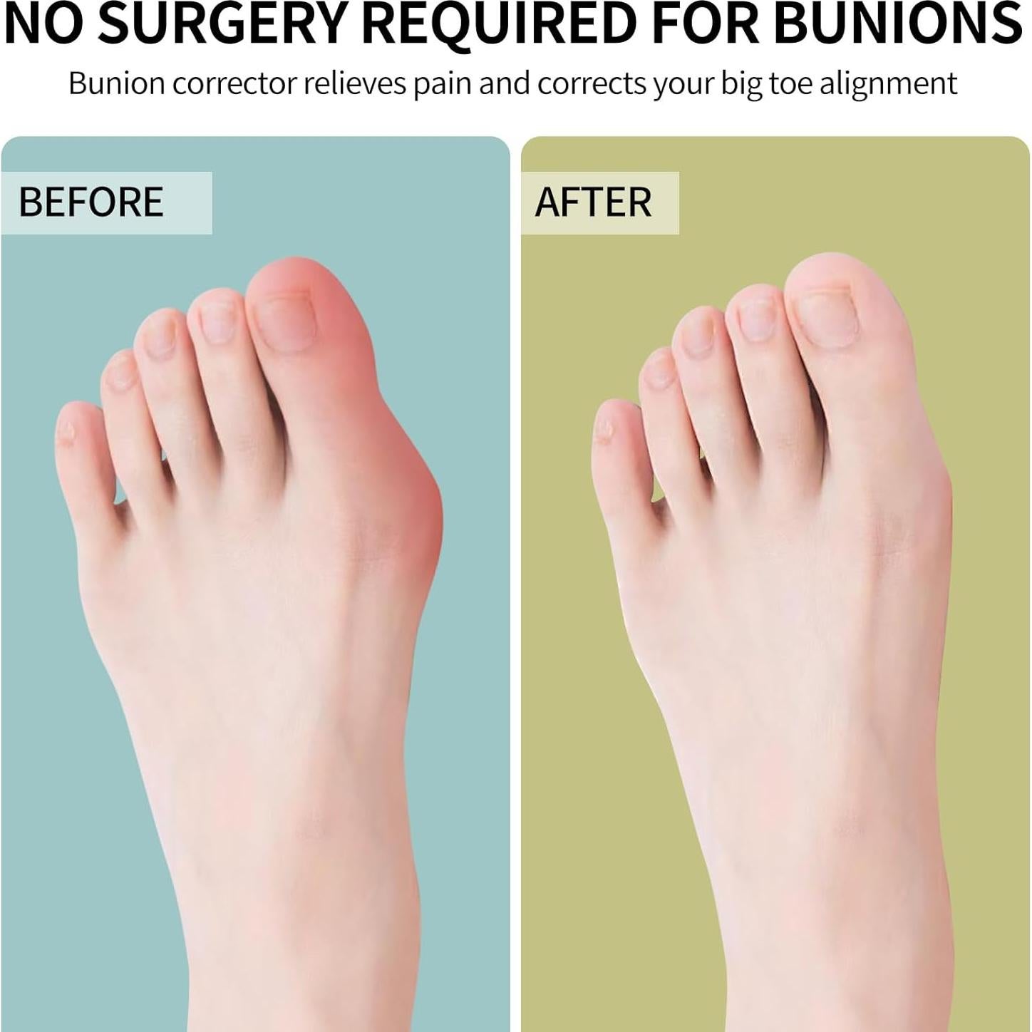 Corrector de Juanetes Ajustable Erouevnket 1 Set Alivio Dedo Gordo