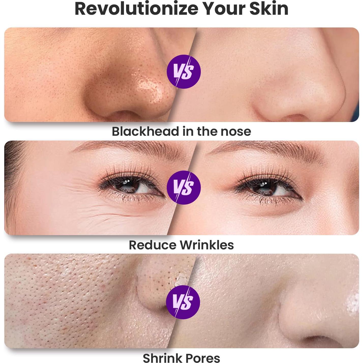 Máquina de Microdermoabrasión UNOISETION Negra con 12 Puntas