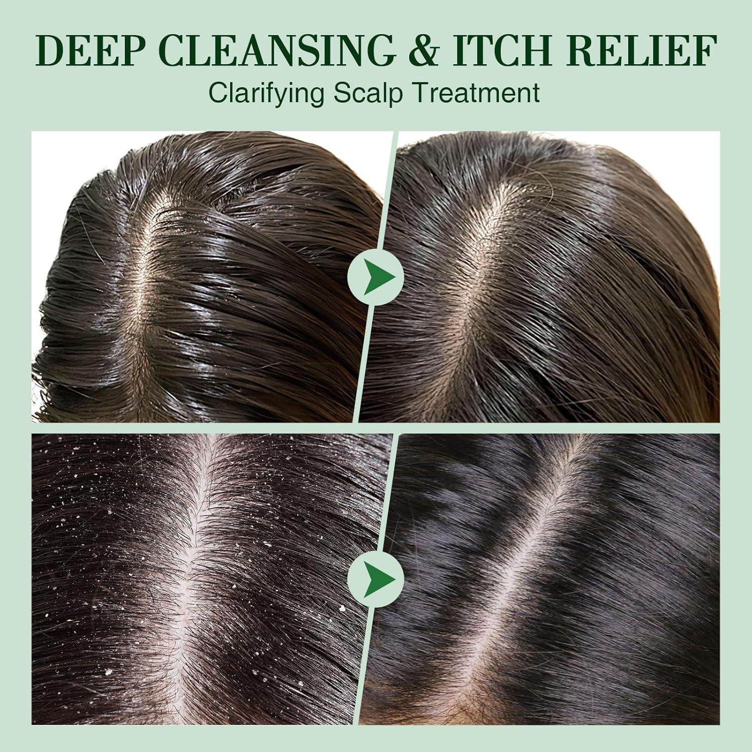 Exfoliante de cuero cabelludo SHVYOG 300 g con aceite de árbol de té