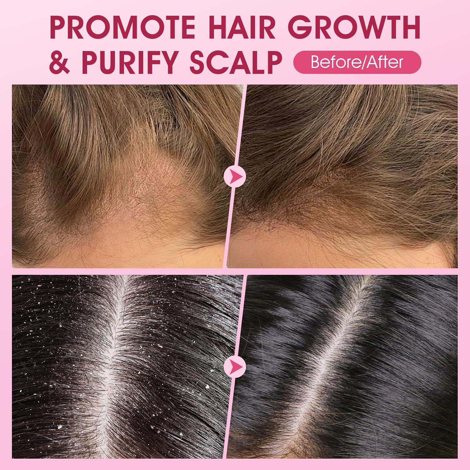 Exfoliante para Cuero Cabelludo VOERUY 300g Biotina y Cebolla