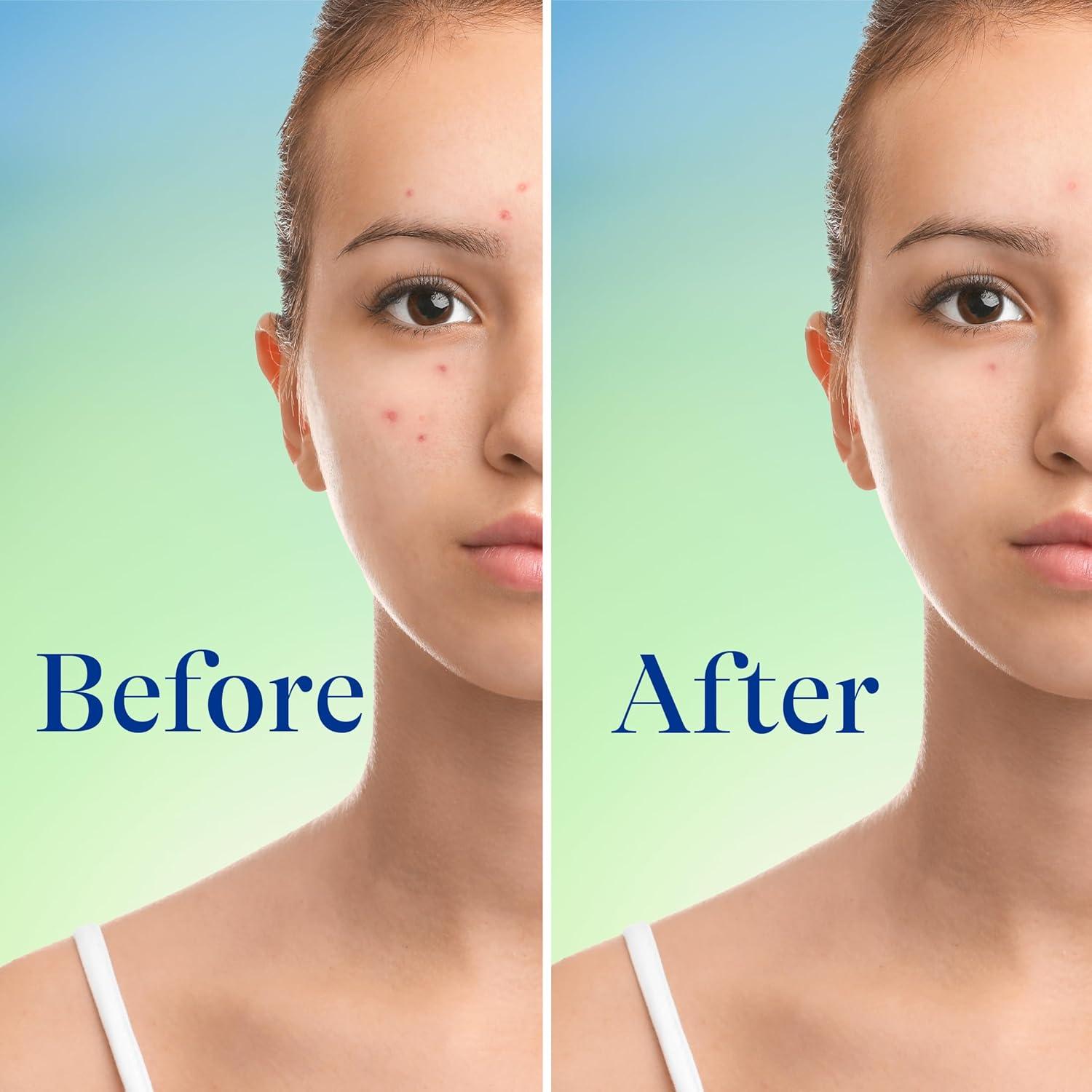 Limpiador Facial Differin 148 ml - 10% Peróxido de Benzoilo