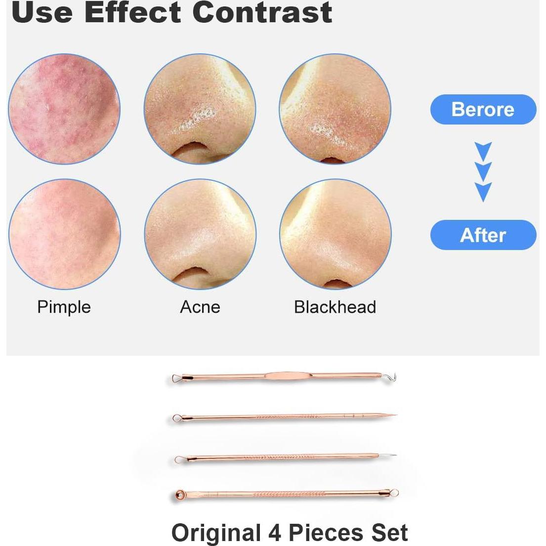 Kit de Extracción de Espinillas HaimiLiya 4 Piezas Oro Rosa