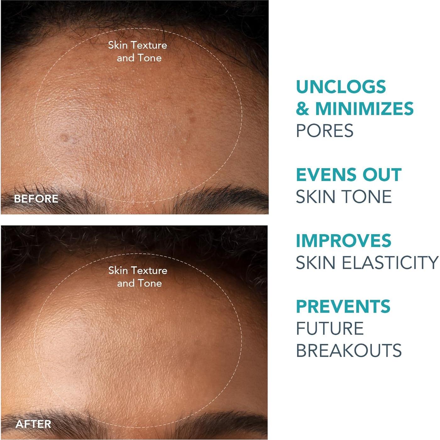 Extractor de Puntos Negros FOREO KIWI - Succión Potente y Higiénico