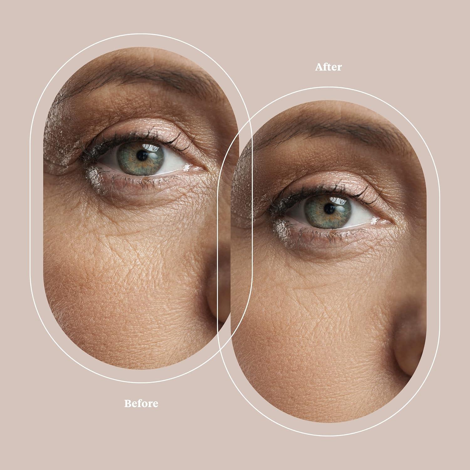 Máquina Exfoliadora Facial Trophy Skin UltradermMD - Spa en Casa