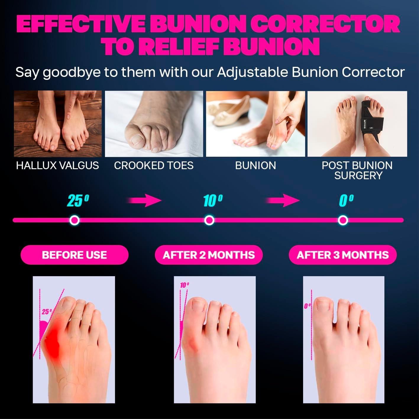 Effective Corrector for Women and Men | Relief Kit, Straighten Toes, and Correct Alignment | Cushion Sleeves | Feet Support - Small/Medium
