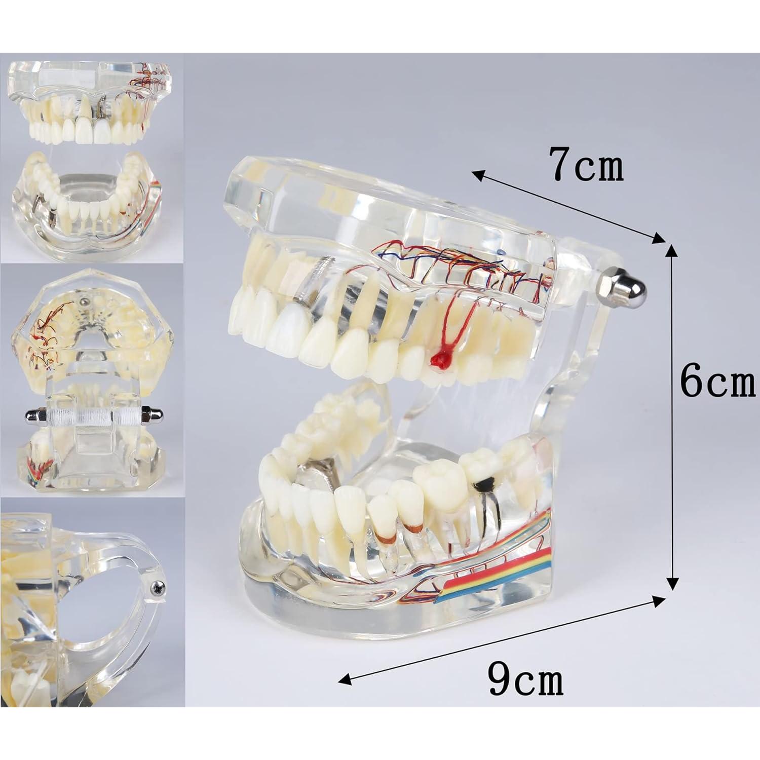Modelo Dental Acrílico YOUYA para Enseñanza 9.4x6.6 cm
