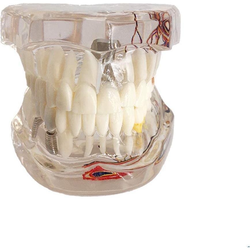 Modelo Dental Acrílico YOUYA para Enseñanza 9.4x6.6 cm